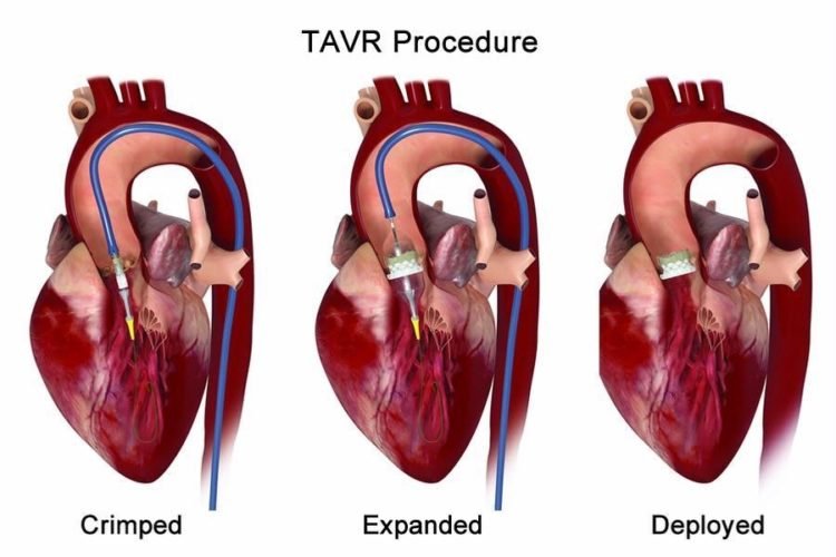 TAVR / TAVI Surgery