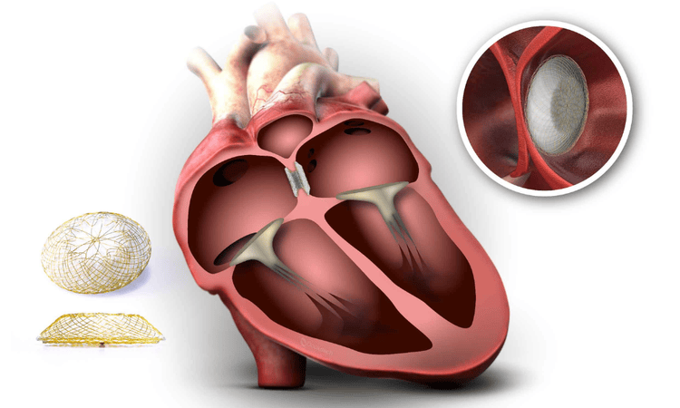 Complex Coronary Angioplasty