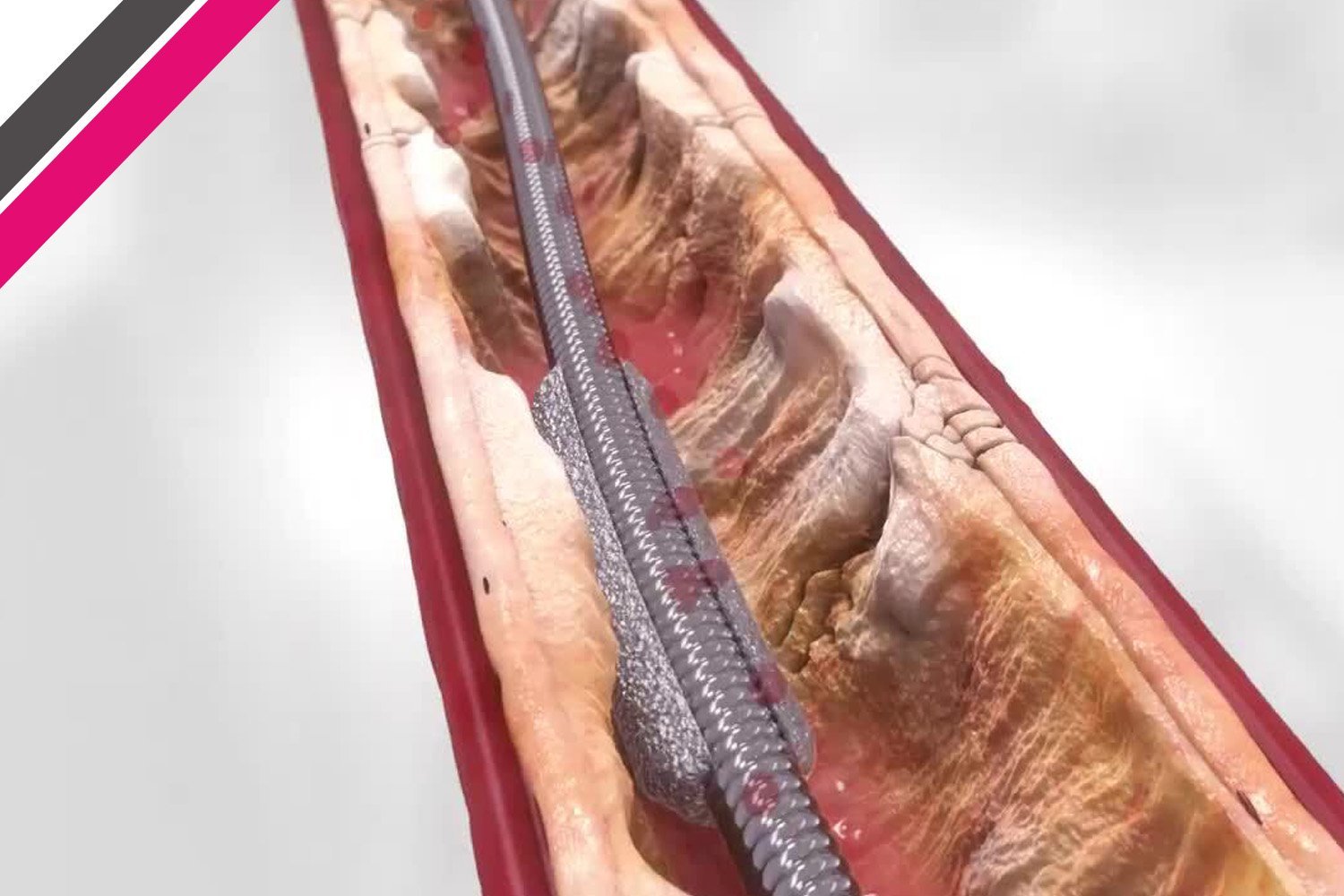 TAVI / TAVR Surgery