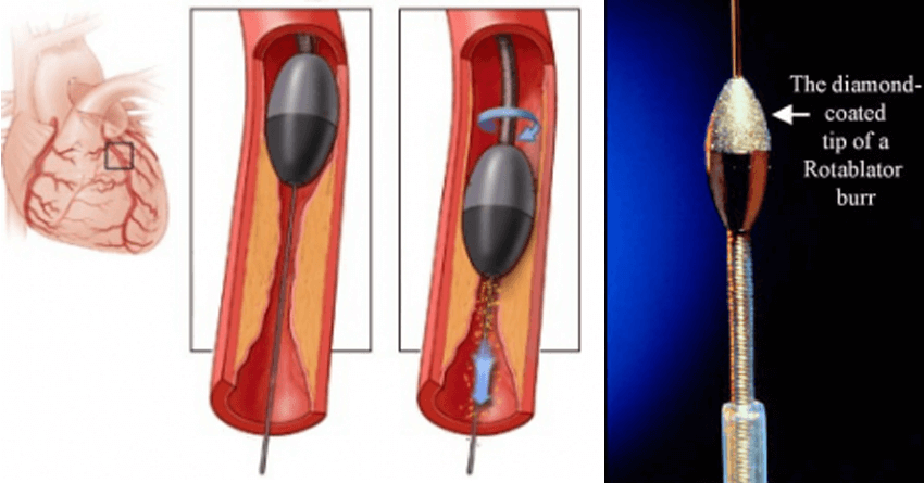 Complex Coronary Angioplasty