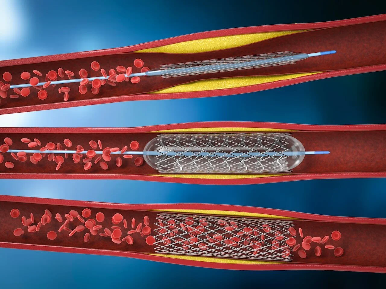 Complex Coronary Angioplasty